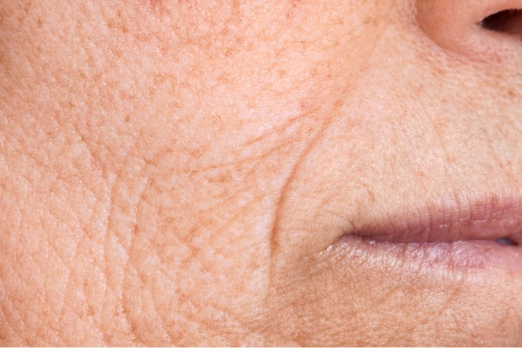 retinol, anti aging, bekas jerawat, dark spots