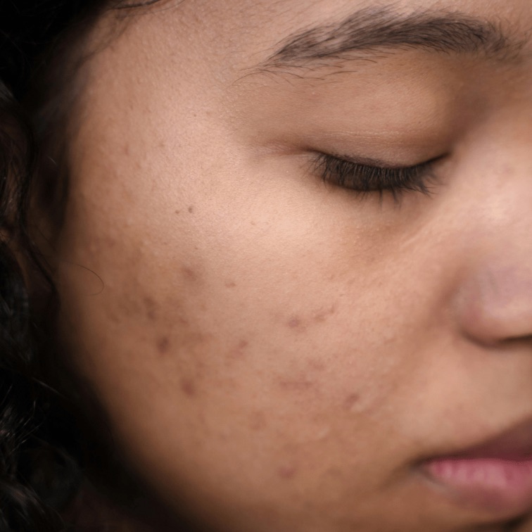 retinol, anti aging, bekas jerawat, dark spots