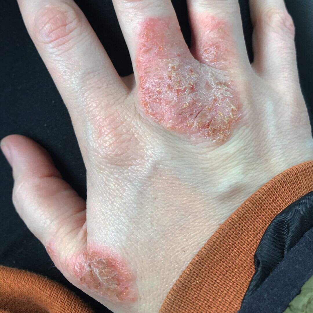 Dermatitis Herpetiformis, Gatal, Alergi