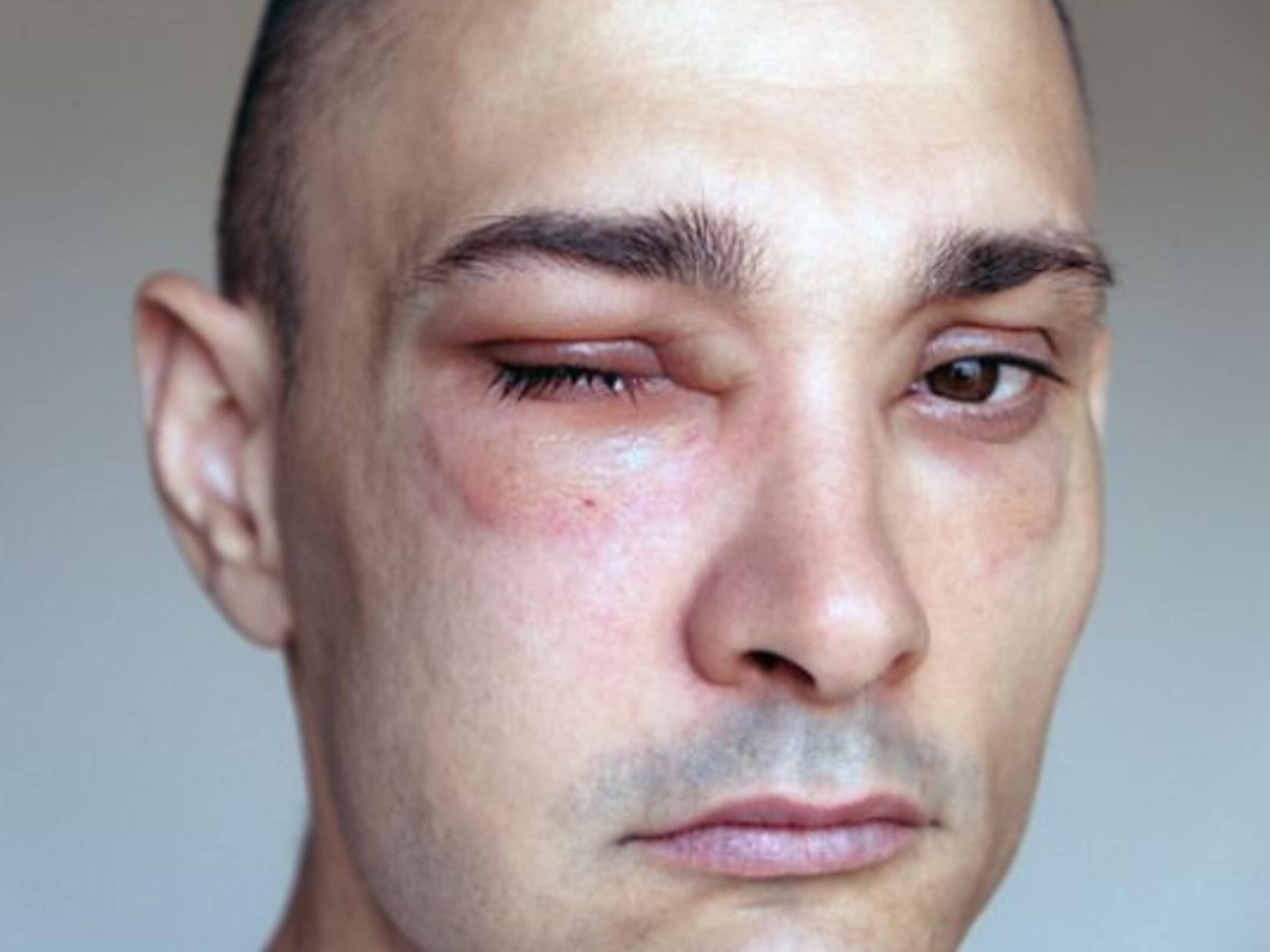 Alergi Kulit, Angioedema, Bengkak, Gatal