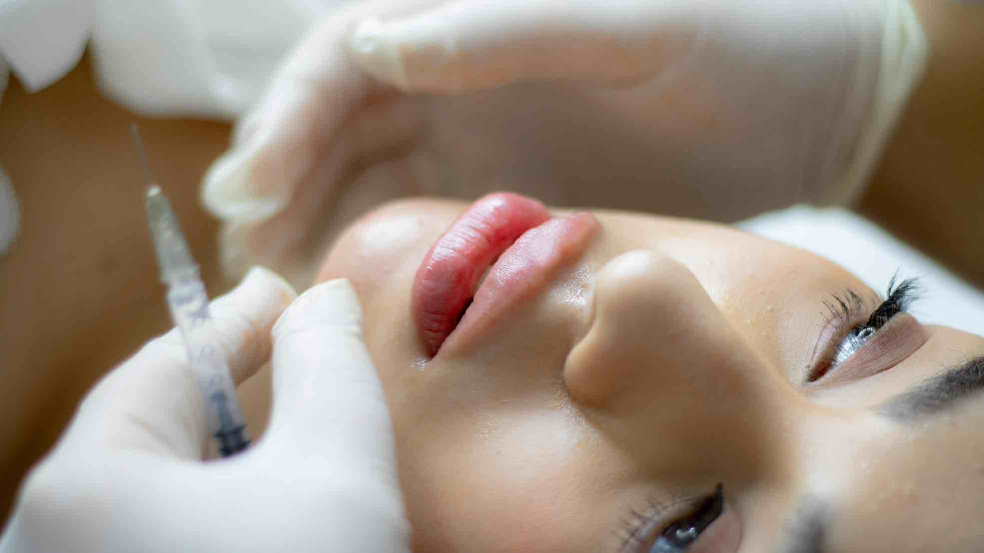 dampak filler bibir yang harus dipahami, dampak filler bibir, filler bibir, filler