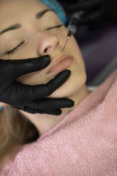 dampak filler bibir yang harus dipahami, dampak filler bibir, filler bibir, filler