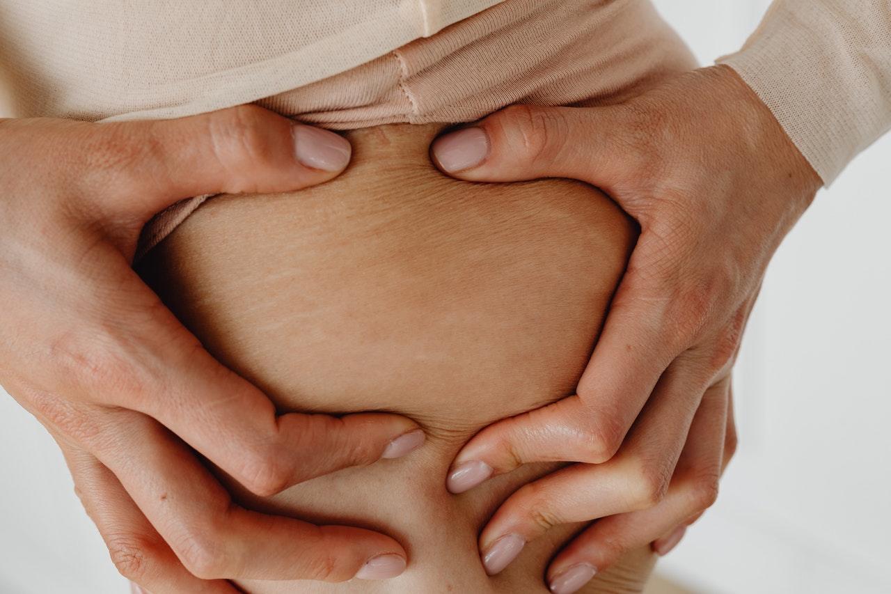 Tips Untuk Menghilangkan Stretch Marks Pada Tubuh