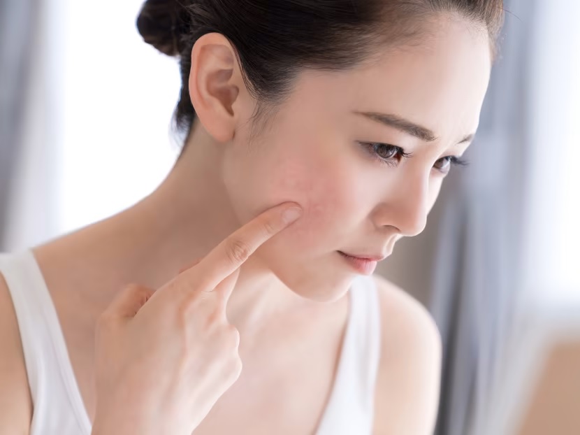 Tips Merawat Kulit Wajah yang Sensitif