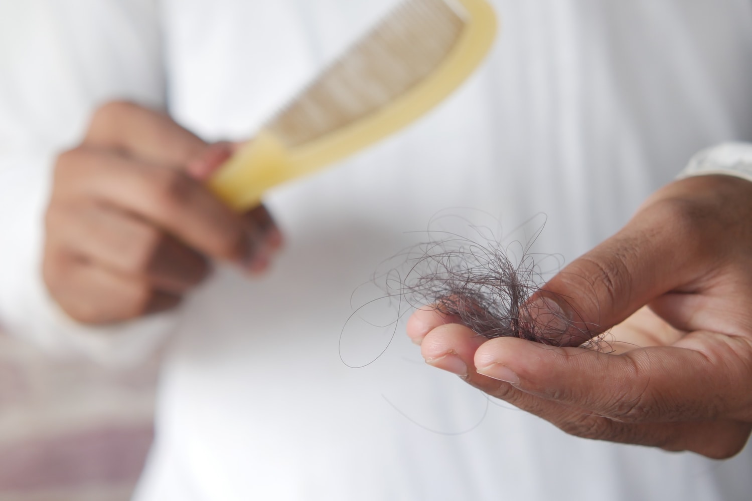 alopecia