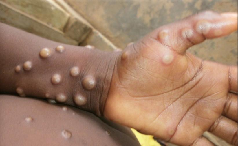 Monkeypox / Cacar monyet