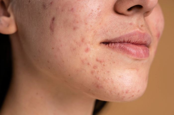 Skincare yang tidak cocok dapat menyebabkan kulit bertekstur