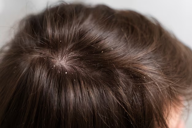 Penyebab Munculnya Rambut Ketombe