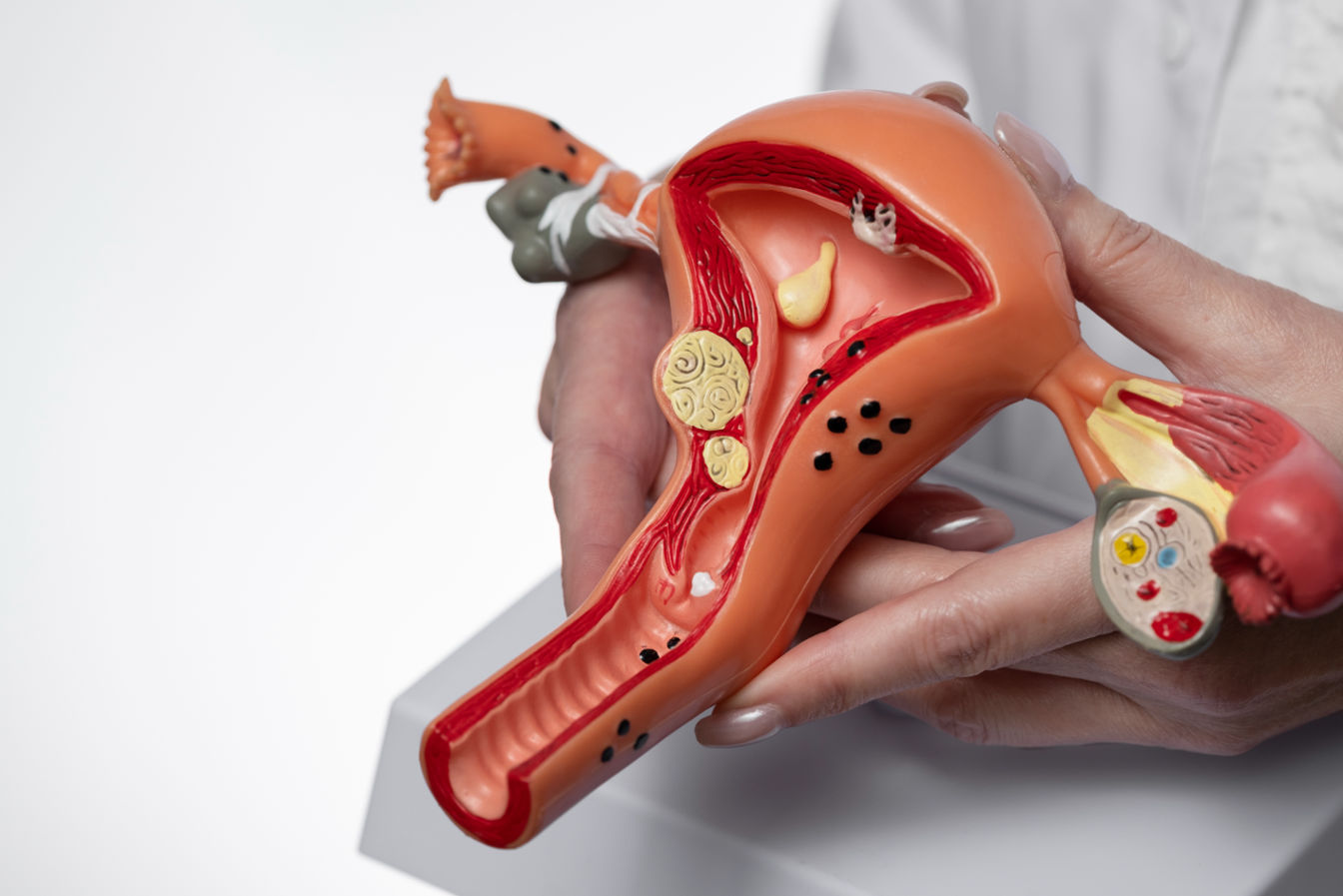 Mayapada Hospital Obstetrics and Gynecology Center, Endometriosis, Nyeri Haid