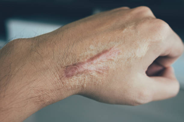 Cara Menghindari Keloid