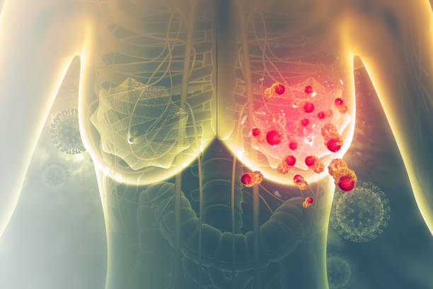Tumor Payudara