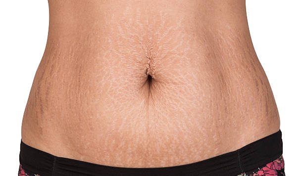 Apakah Stretch Mark Bisa Hilang