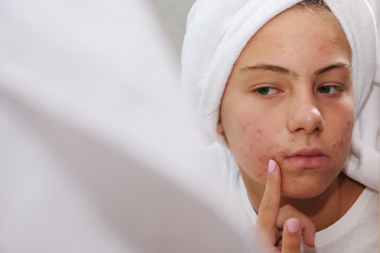 Kenali Manfaat Kandungan Salicylic Acid dalam Skincare