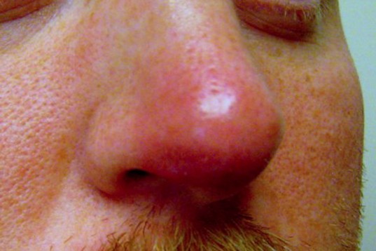 jerawat di hidung
