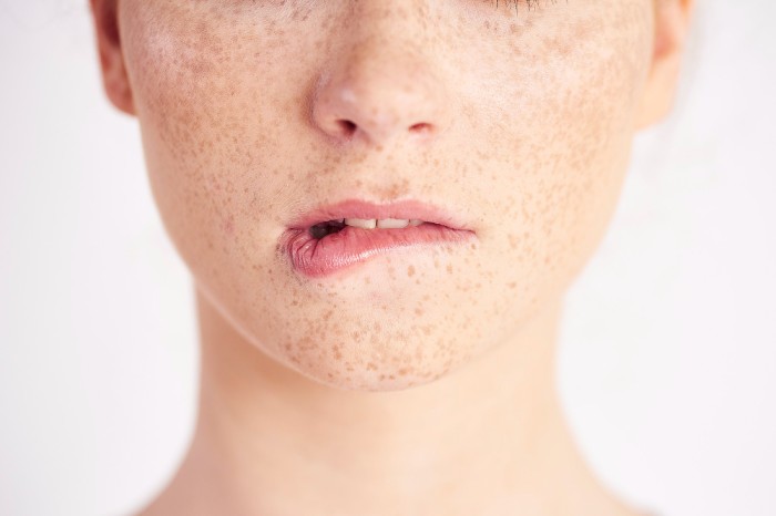 Retinol bantu hilangkan noda hitam akibat sinar UV