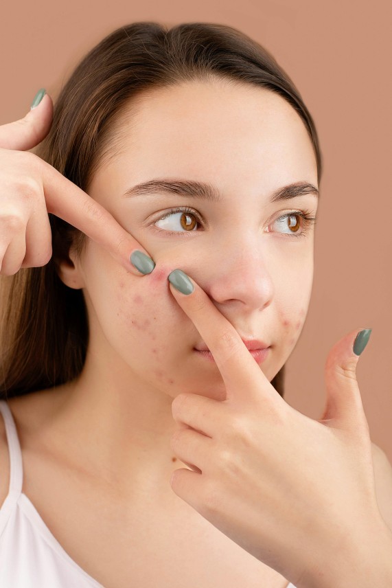 tips merawat kulit beruntusan, beruntusan, pola hidup, niacinamide, salicylic acid