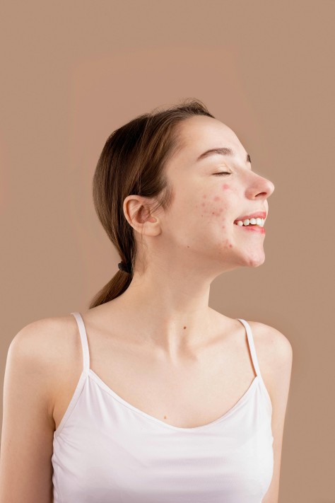 adult acne, masalah jerawat dewasa, kulit semakin terjaga, apa itu adult acne