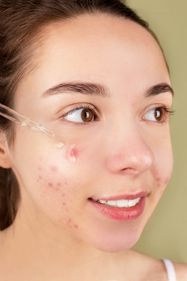 tips merawat kulit beruntusan, beruntusan, pola hidup, niacinamide, salicylic acid