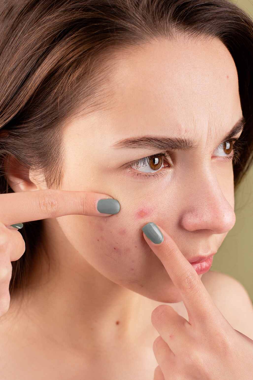 Manfaat vitamin D untuk wajah dalam mengobati jerawat pada kulit.