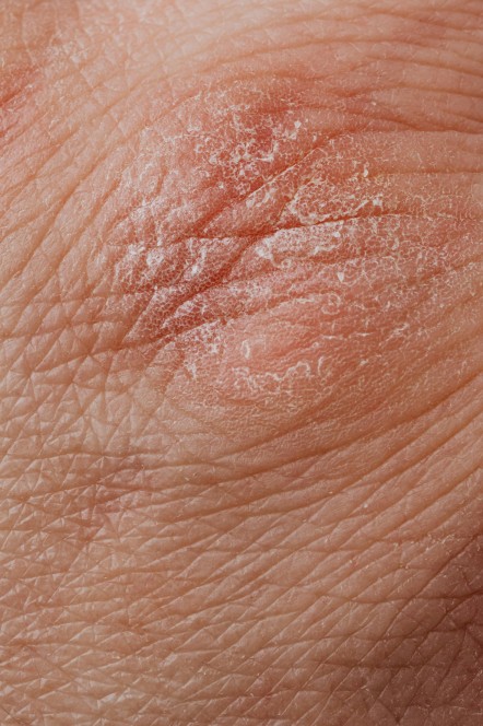 ciri psoriasis pada kulit yang timbul, psoriasis, kulit kering, kulit bersisik