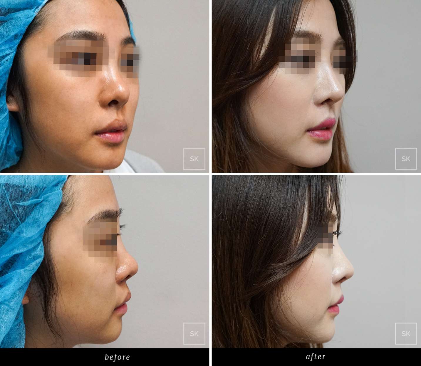 jenis implan hidung