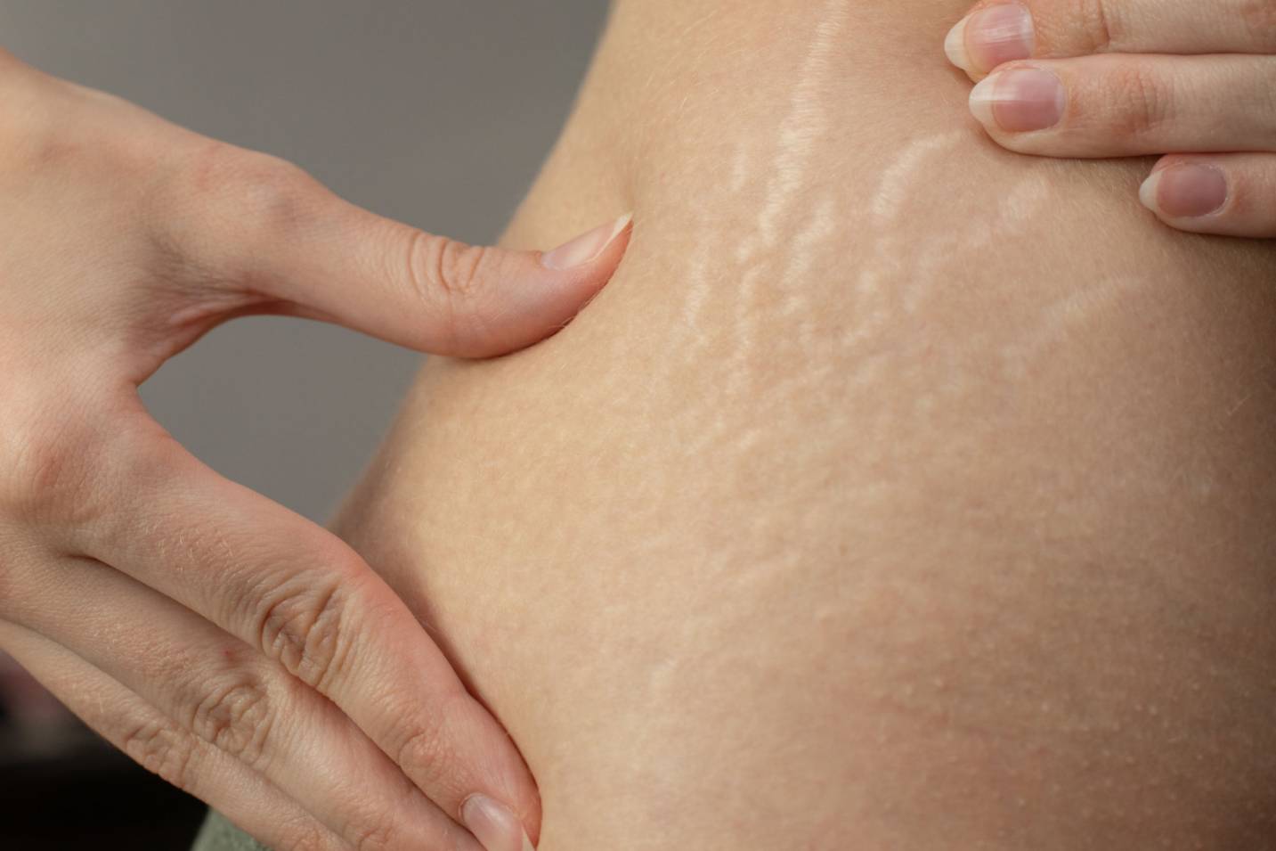 penyebab stretch mark