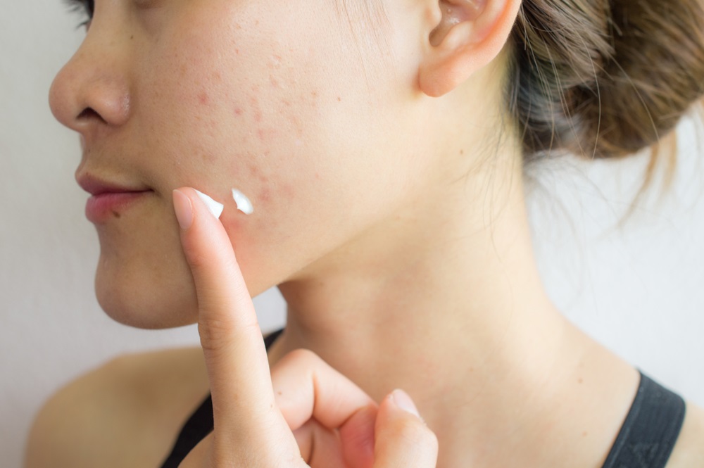 Manfaat Tretinoin Untuk Wajah