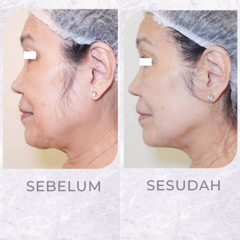 Perawatan Ultherapy di ZAP Premiere