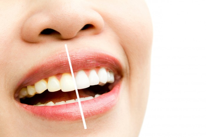 (Teeth whitening dapat bantu membunuh banteri sebabkan sakit gigi. Foto: Dok. freepik)