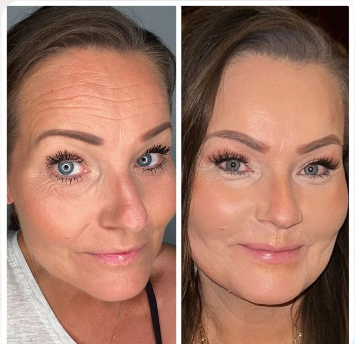 Wrinkle Patches Solusi Alternatif Botox