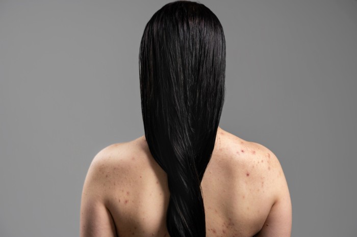 Jauhi rambut pada punggung yang sedang berjerawat