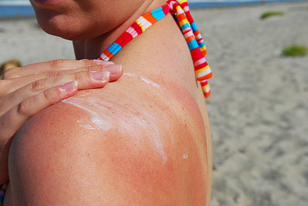 Coba 6 Cara Menghilangkan Sunburn Dengan Cepat, Penasaran?