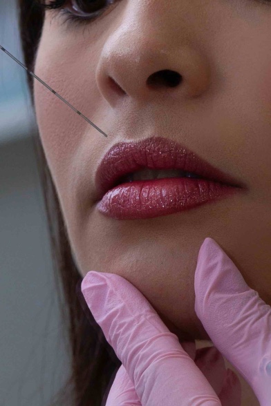 5 Efek Filler Bibir yang Wajib Kamu Tahu, Apa Saja?