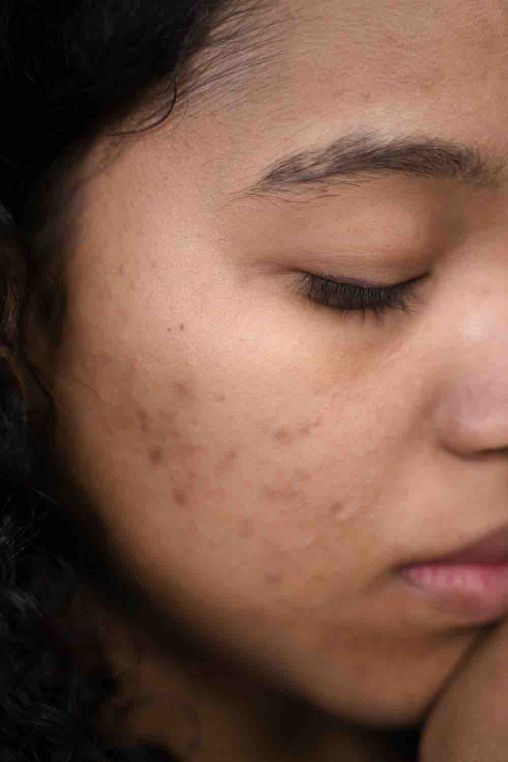 Apa Itu Bekas Jerawat dan 7 Tips Menghilangkannya