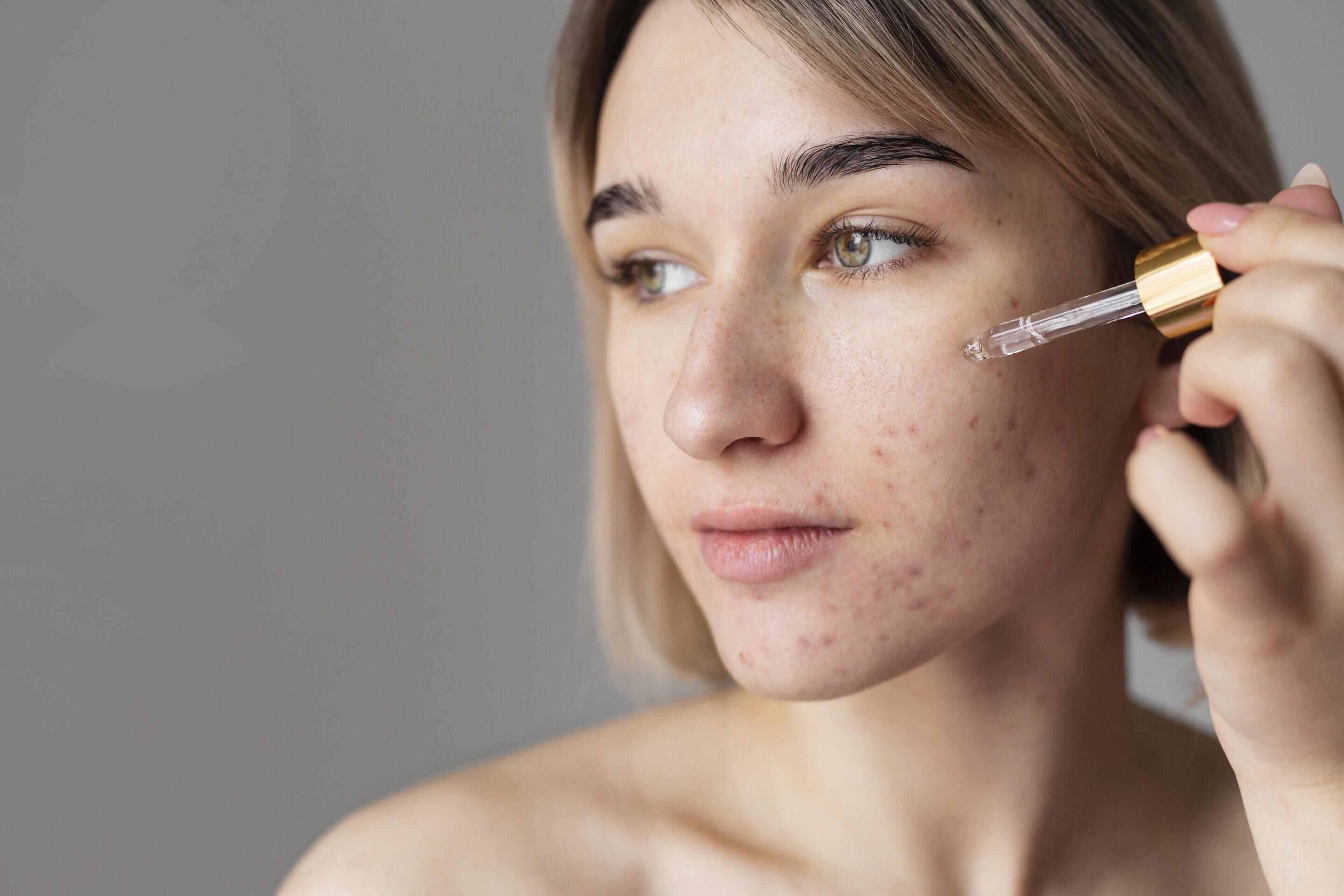 Hempaskan Jerawat Dengan 5 Rekomendasi Acne Spot Lokal Ini!