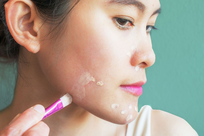 Catat, Ini 4 Tips Menggunakan Concealer Untuk Tutupi Jerawat