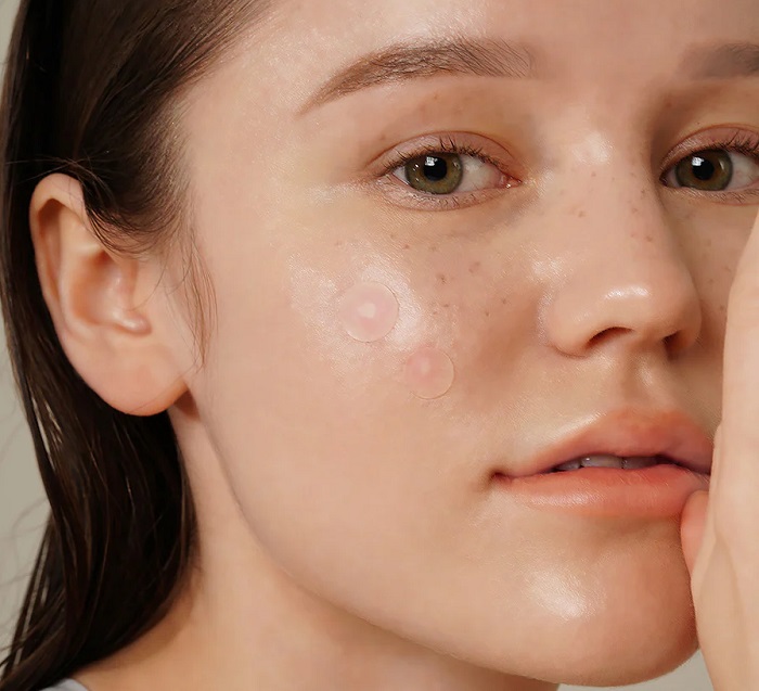 Hilangkan Jerawat, Ini 4 Tipe Acne Patch yang Bisa Kamu Coba