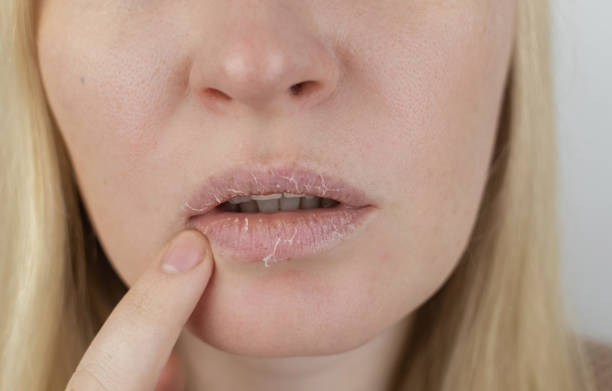 Selain Minum Air, Ini 6 Cara Mengatasi Bibir Kering 