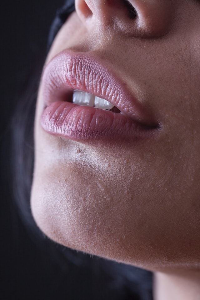 Mudah &Praktis, Ini Cara Atasi Bibir Pecah Secara Alami