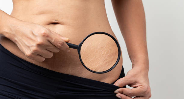 Apakah Stretch Mark Bisa Hilang? Intip 4 Cara Termudah Ini