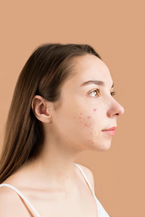 7 Cara Mengatasi Jerawat Hormonal Yang Harus Kamu Ketahui