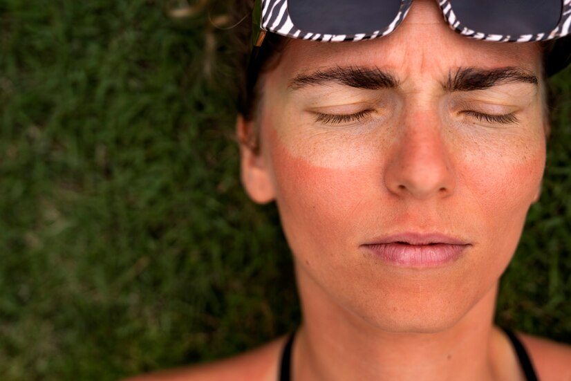 Awas! Ini Bahaya dan Tanda-tanda Kamu Alami Sunburn